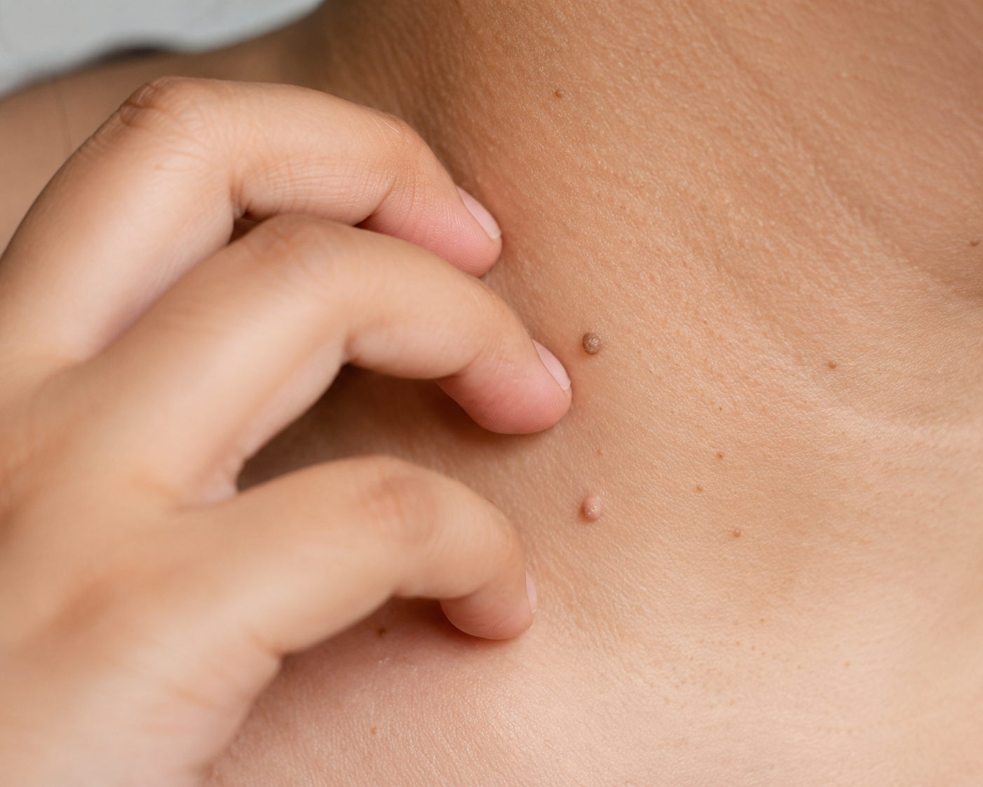 scratching on itchy skin tags