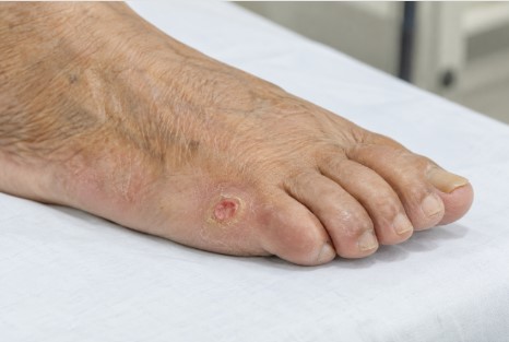 Image Diabetic Wound
